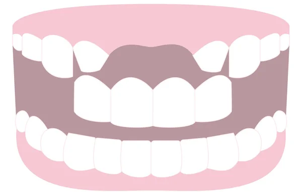 Εικόνα Ενός Δοντιού Που Γεφυρώνει Χαμένο Μπροστινό Δόντι — Διανυσματικό Αρχείο