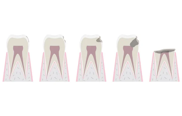 Ilustração Progresso Cárie Dentária — Vetor de Stock