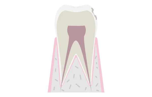 Progresso Cárie Dentária Superfície Dente Começa Derreter — Vetor de Stock