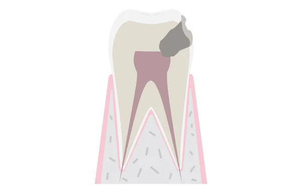 Voortgang Van Cariës Cariës Bereiken Tand Zenuw — Stockvector