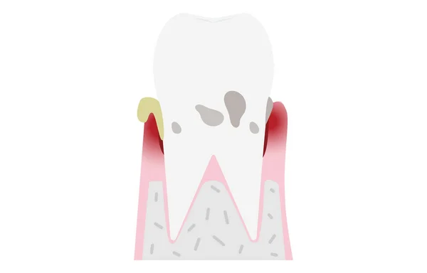 Illustration Par Stade Maladie Parodontale Parodontite Modérée — Image vectorielle