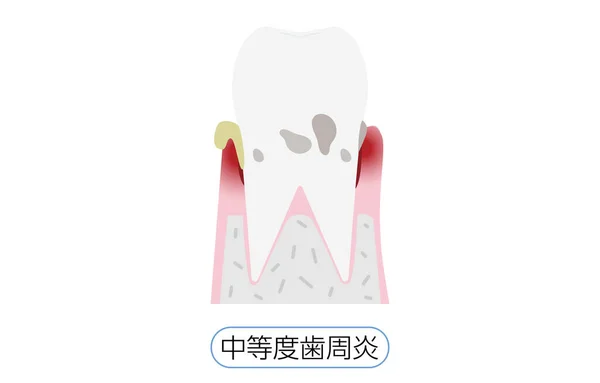 Ilustración Por Estadio Enfermedad Periodontal Periodontiti Moderado — Vector de stock