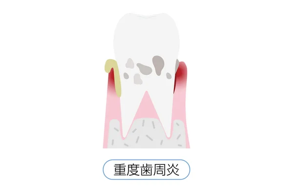 Ilustración Por Estadio Enfermedad Periodontal Periodontiti Grave — Vector de stock