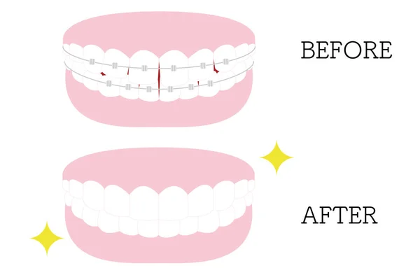 Ilustração Odontologia Estética Ortodontia Arranjo Dentário Distorcido Bonito Com Suporte — Vetor de Stock