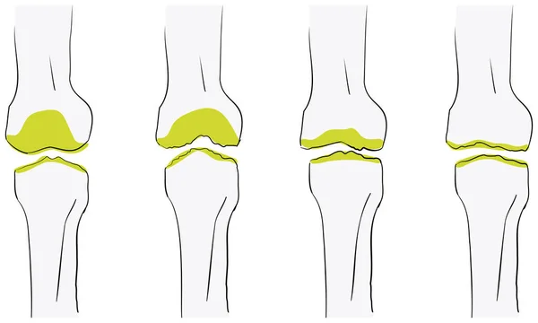 Ilustração Vetorial Fluxo Osteoartrite Joelho Pior — Vetor de Stock