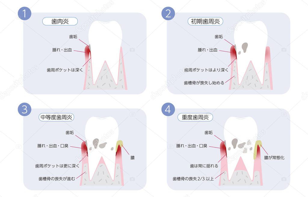 Periodontal disease progression illustration, 4 stage