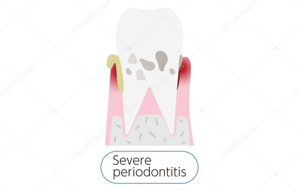 Illustration by stage of periodontal disease: severe periodontitis