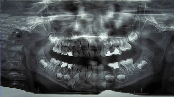 Panoramiczne Prześwietlenie Górnych Dolnych Zębów Szczęki Dziecka Uszkodzonymi Zębami Mlecznymi — Zdjęcie stockowe