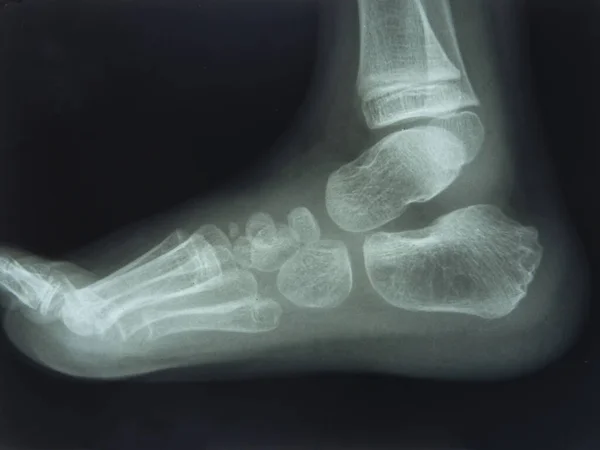 Noha a prsty. Lidská noha v rentgenovém snímku — Stock fotografie