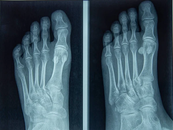 Foot and Toes. Human Leg in the X-ray image — Φωτογραφία Αρχείου