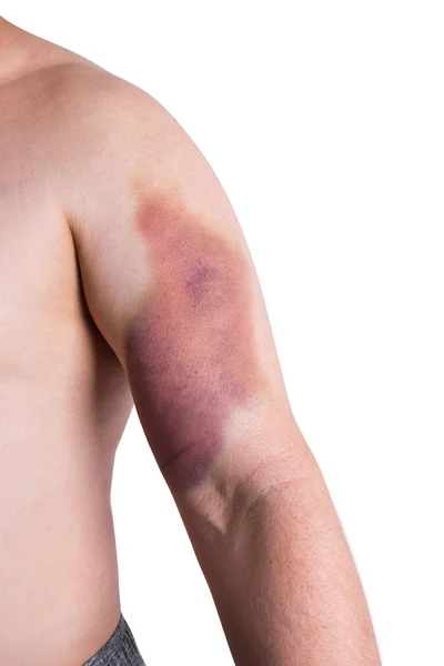 Large bruise on man's arm — Stock Photo, Image