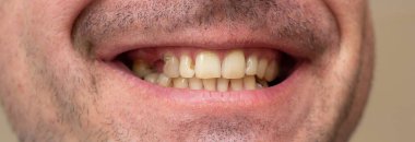 Sigara içen bir erkeğin dişleri çürük. Bakımlar ve dolgular. Sarı dişli. Ağzına yakın çekim. Bir yazıt için yer.