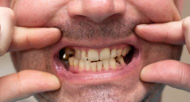 Sigara içen bir erkeğin dişleri çürük. Bakımlar ve dolgular. Sarı dişli. Ağzına yakın çekim. Bir yazıt için yer.