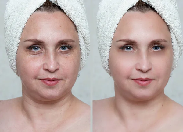 Yaşından Büyük Orta Yaşlı Güzel Bir Kadın Biorevitalizasyon Prosedüründen Önce — Stok fotoğraf