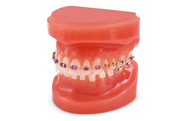 Braces model — Stock Photo, Image