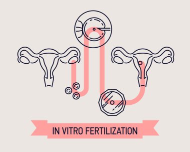 Düz çizgi In Vitro fertilizasyon diyagramı