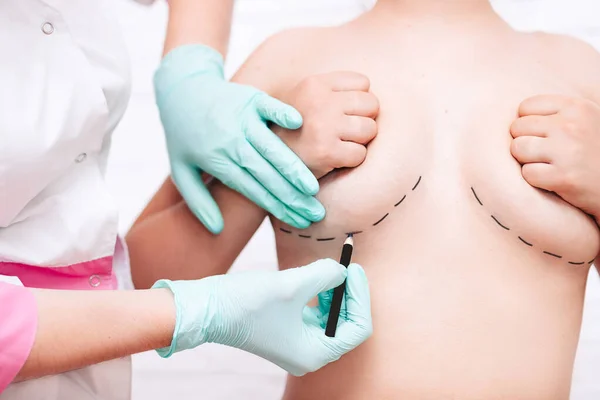 Műanyag mellkorrekció. mellnagyobbító műtét.egy plasztikai sebész jelöli a nők test műtét korrigálni az ábra — Stock Fotó