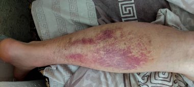 Gastrocnemius kaslarında yırtık var. Spor sakatlığı. İç kanama var. Geniş çaplı çürükler. ağır yaralanma.