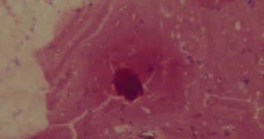 Hastanede mikroskop altında bakteriler