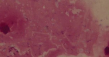 Hastanede mikroskop altında bakteriler