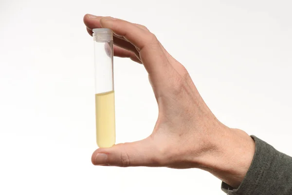 Urine Sample Medical Diagnostics Urea Testing Preventive Medical Checkup — Stock Photo, Image