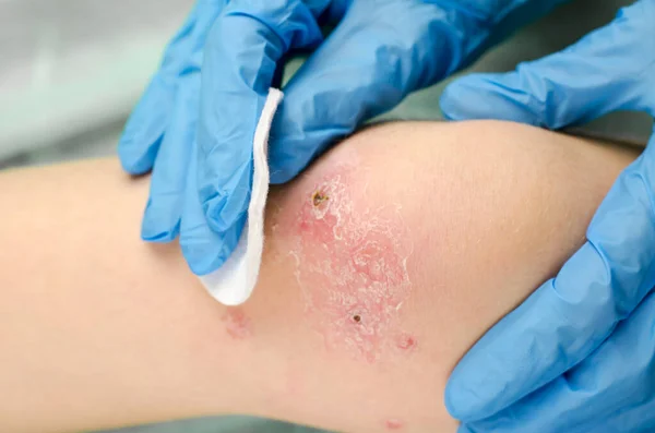 Doctor Treats Wound Knee Child — Stock Photo, Image