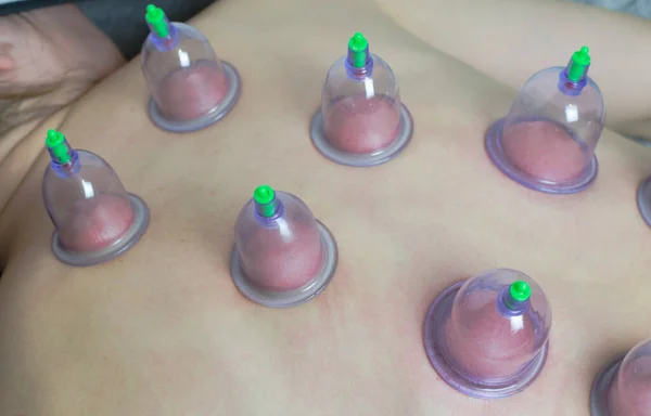 Vacuum medical cups on a woman\'s back, close-up. Health and healthy lifestyle concept