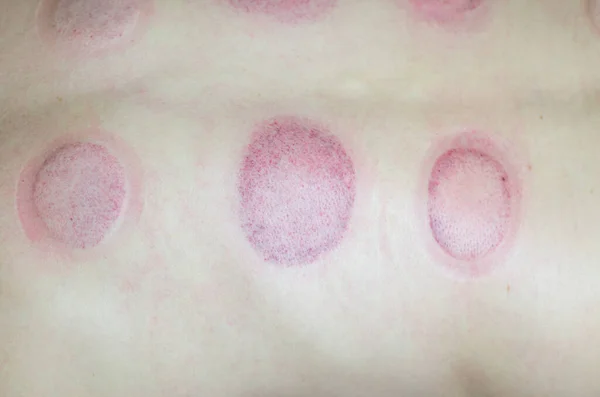 Hematomas Nas Costas Após Ampola Volta Após Acupressão Fechar — Fotografia de Stock