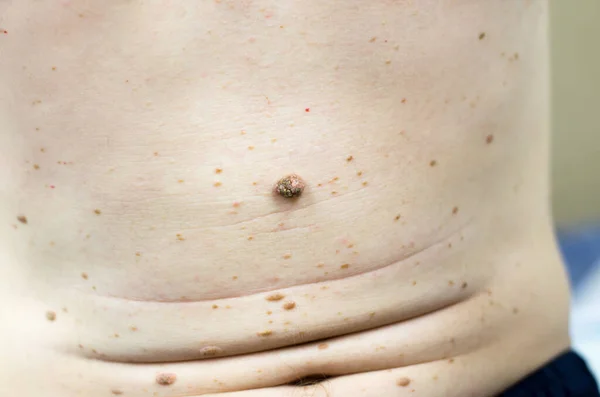 External skin diseases. Rash on the skin of a man in the form of moles, warts and papillomas