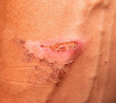 Deride termal yanık