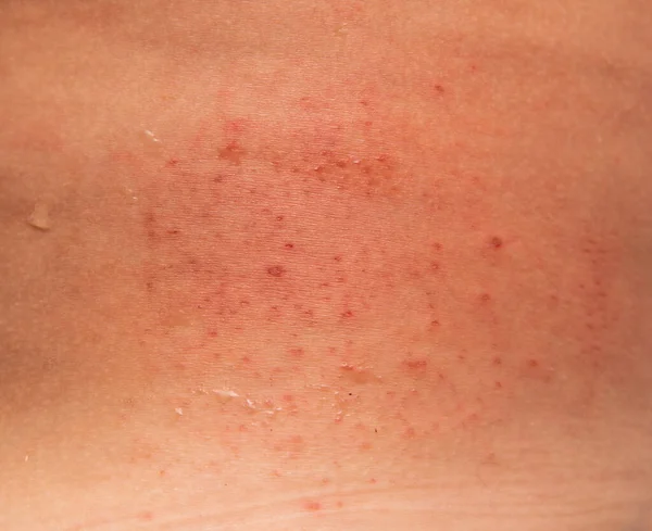 Allergic Rash Skin Back — Stock Photo, Image