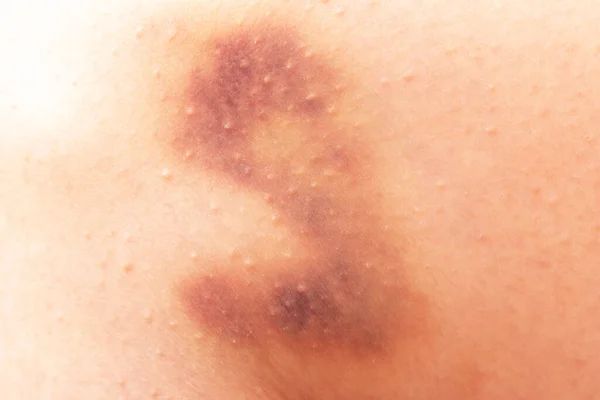 Bruise Skin — Stock Photo, Image