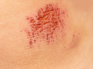 Çocuğun dizinde aşınma var.