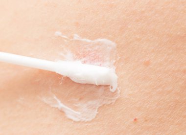 Deride mantar kurdu.