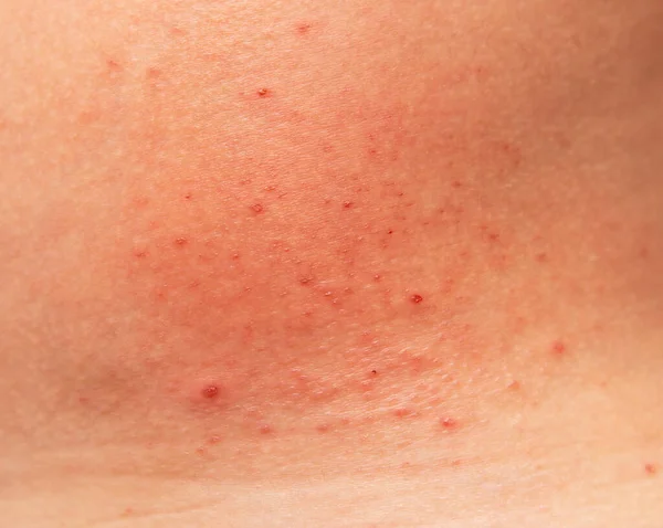 Аллергическая Сыпь Коже Спины — стоковое фото