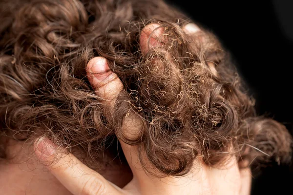 Cabelo Queimado Cabeça — Fotografia de Stock