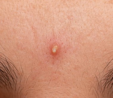 Yüzünde iltihaplı sivilce var.