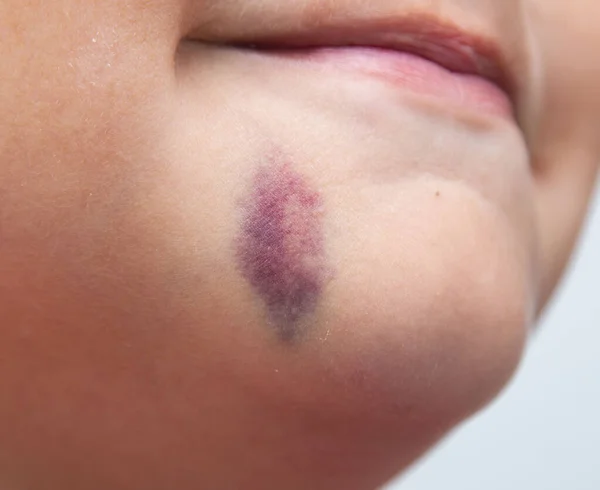 Bruise Skin Face — Stock Photo, Image