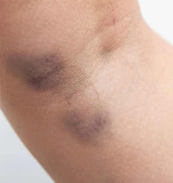 Large Bruise Skin Leg — Stock Photo, Image