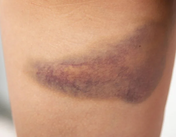 Large Bruise Skin Leg — Stock Photo, Image