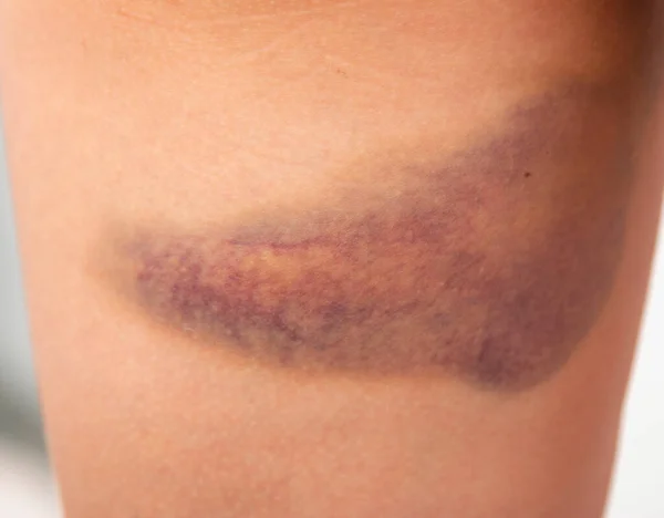 Large Bruise Skin Leg — Stock Photo, Image