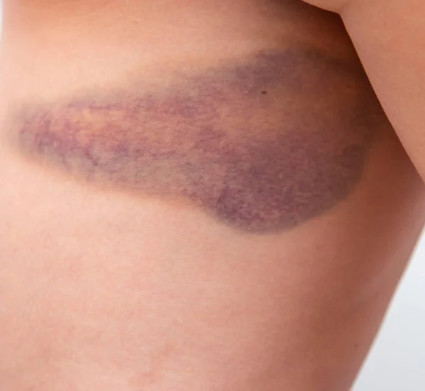 Large Bruise Skin Leg — Stock Photo, Image