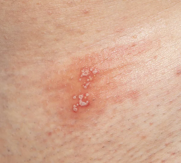 염증의 형태로 생기는 피부염 — 스톡 사진