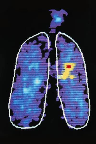 인간의 폐에 질병을 표시 하는 그래픽 이미지 — 스톡 사진