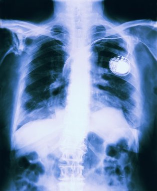 X Ray Of Chest Showing Pacemaker Fitted clipart