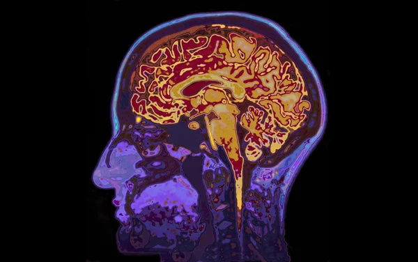 MRI Image Of Head Showing Brain — Stock Photo, Image