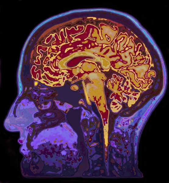 Изображение головного мозга с помощью МРТ — стоковое фото