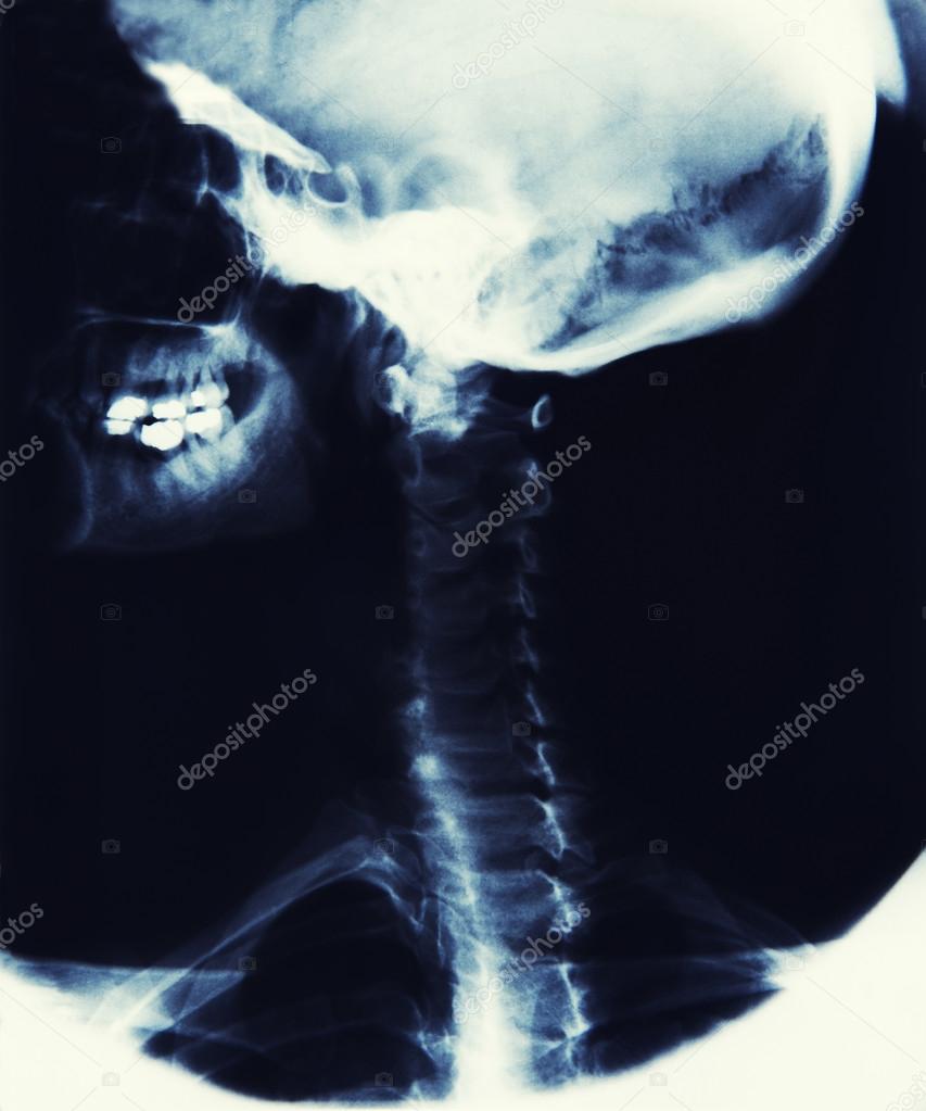 X Ray Image Showing Skull, Jaw And Spine Stock Photo by ©HighwayStarz