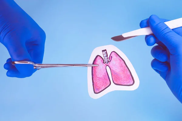 Cirugía en los pulmones. imagen dibujada a mano del órgano. — Foto de Stock