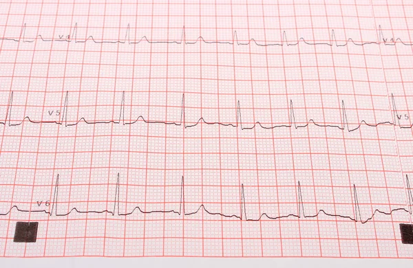 Elektrokardiogram wykres raportu — Zdjęcie stockowe